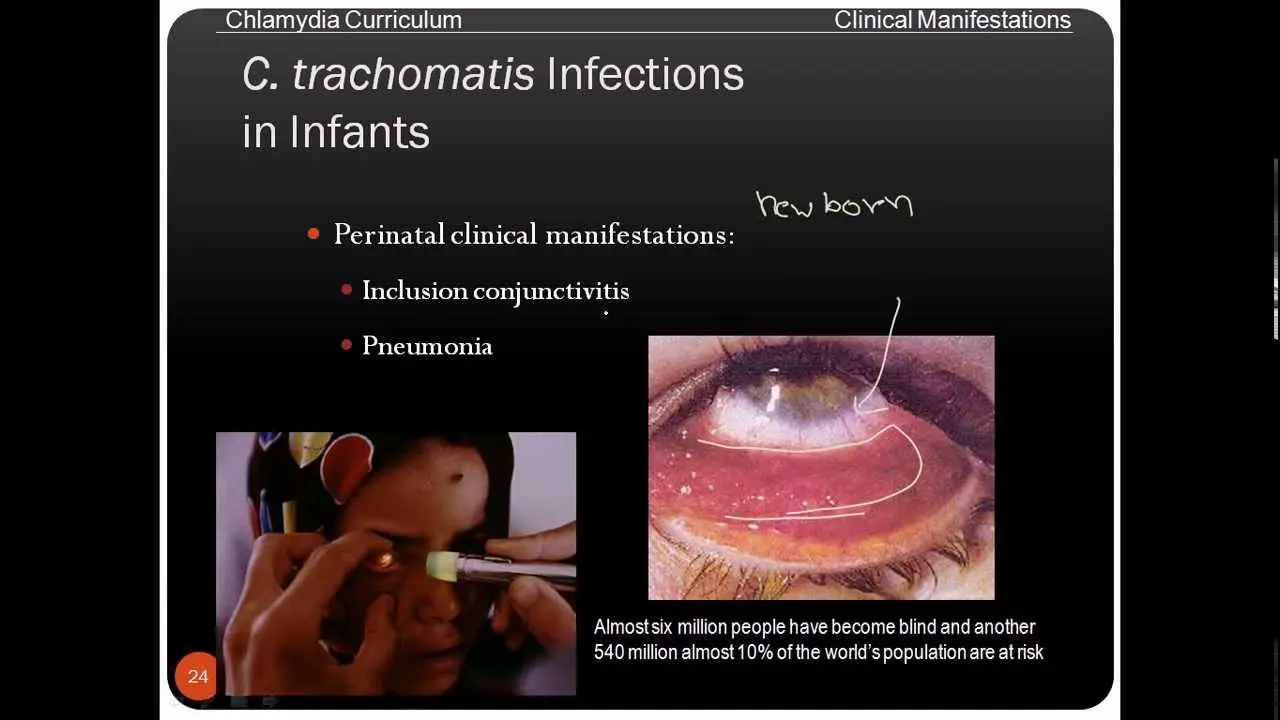 Chlamydia trachomatis &#8211; clinical signs of infection