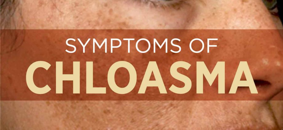 Chloasma &#8211; what is it and how to treat it? Causes and diagnosis of chloasma