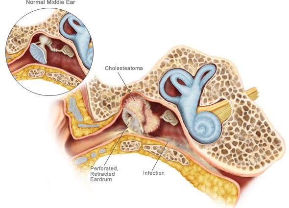 Cholesteatoma &#8211; causes, symptoms, diagnosis and treatment of the disease