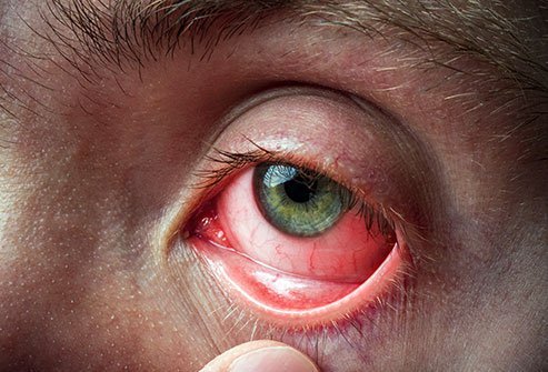 Chromatosis on the eye &#8211; symptoms, diagnosis, treatment. Home remedies for a hail