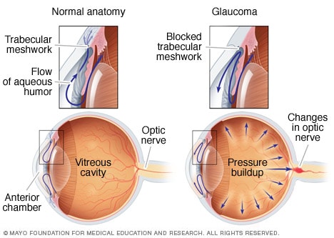 Chronic glaucoma