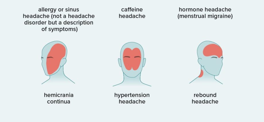 chronic-headache-and-face-pain-causes-types-diagnostics-healthy