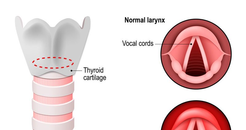 Chronic inflammatory diseases of the larynx &#8211; symptoms and treatment