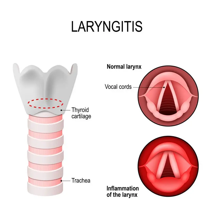 Chronic inflammatory diseases of the larynx &#8211; symptoms and treatment