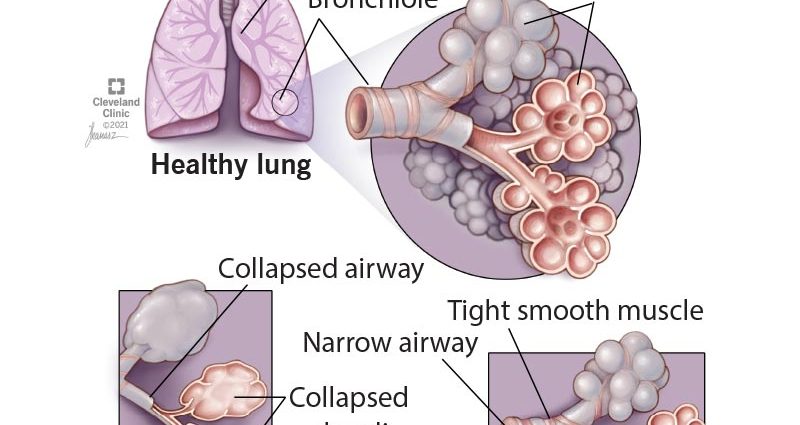 Chronic obstructive pulmonary disease (COPD) &#8211; symptoms, diagnosis, treatment