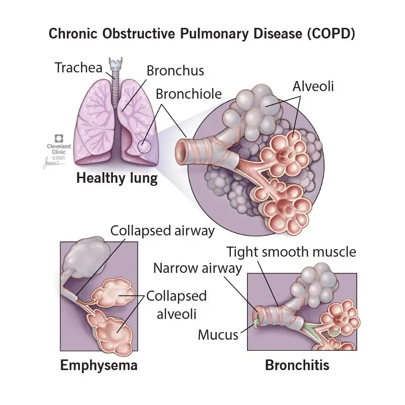 Chronic obstructive pulmonary disease (COPD) &#8211; symptoms, diagnosis, treatment