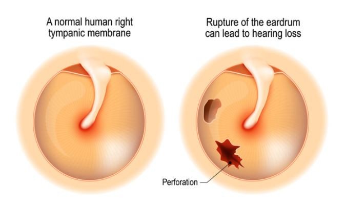 Chronic otitis media