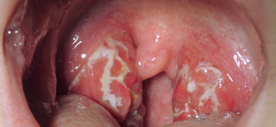 Chronic purulent inflammation of the palatine tonsils