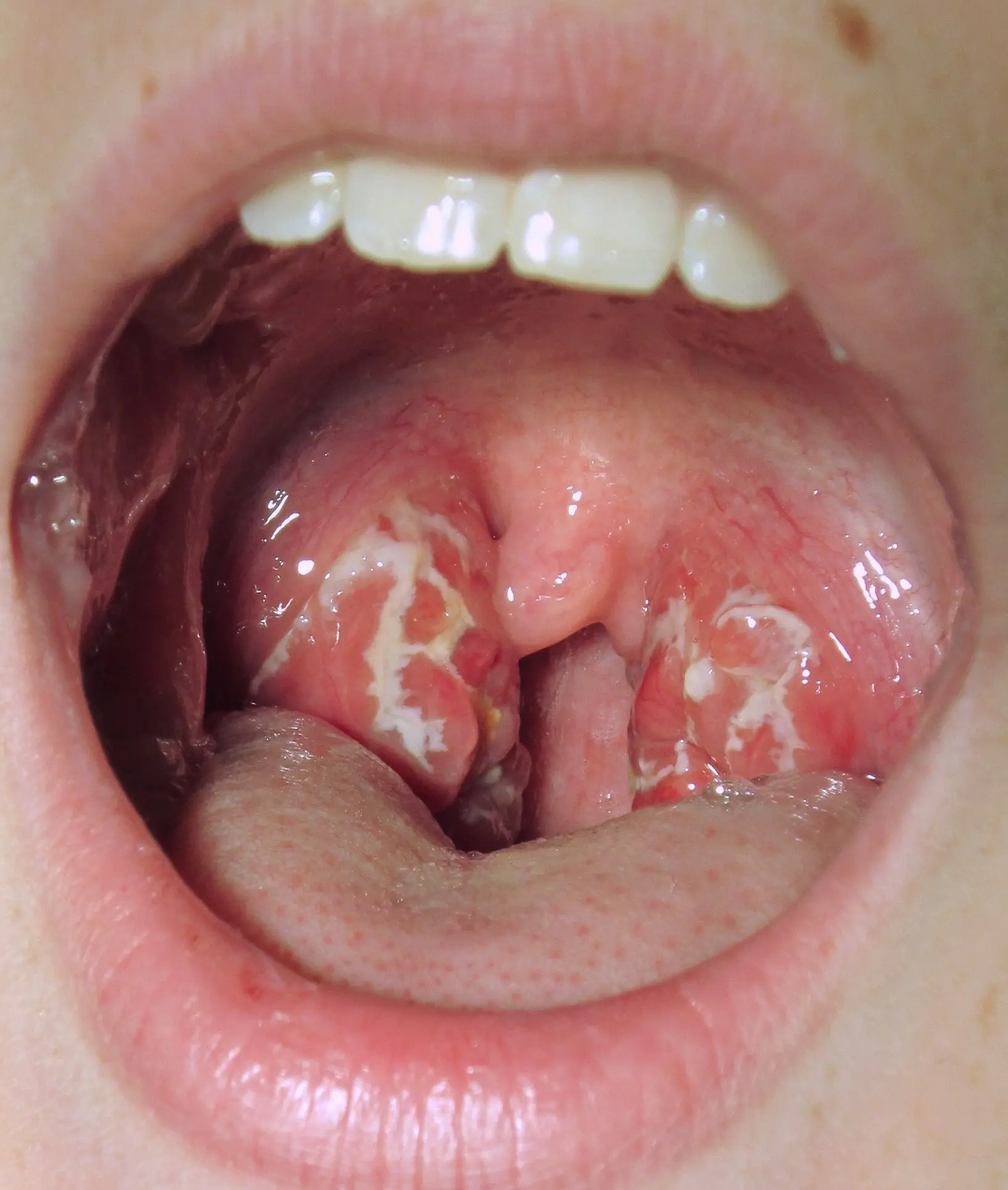 Chronic purulent inflammation of the palatine tonsils