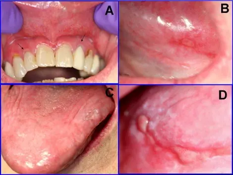 Chronic ulcerative stomatitis