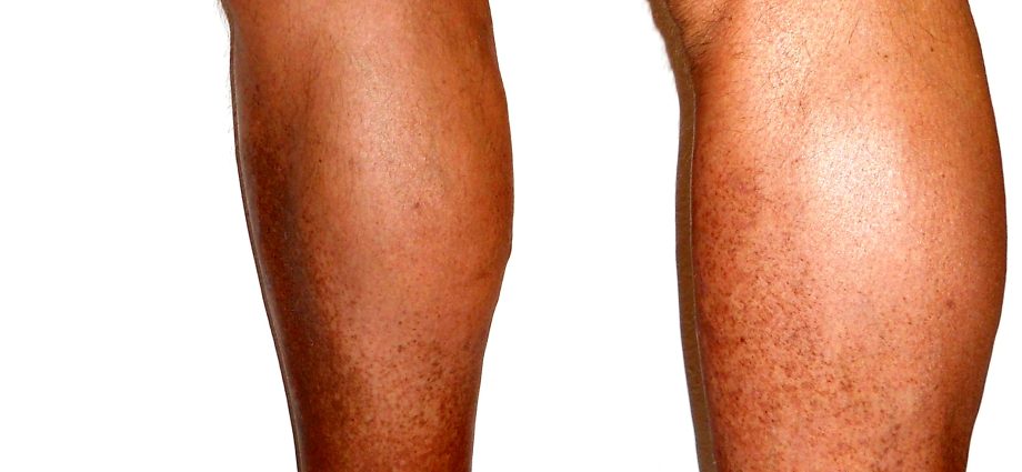 Chronic venous insufficiency