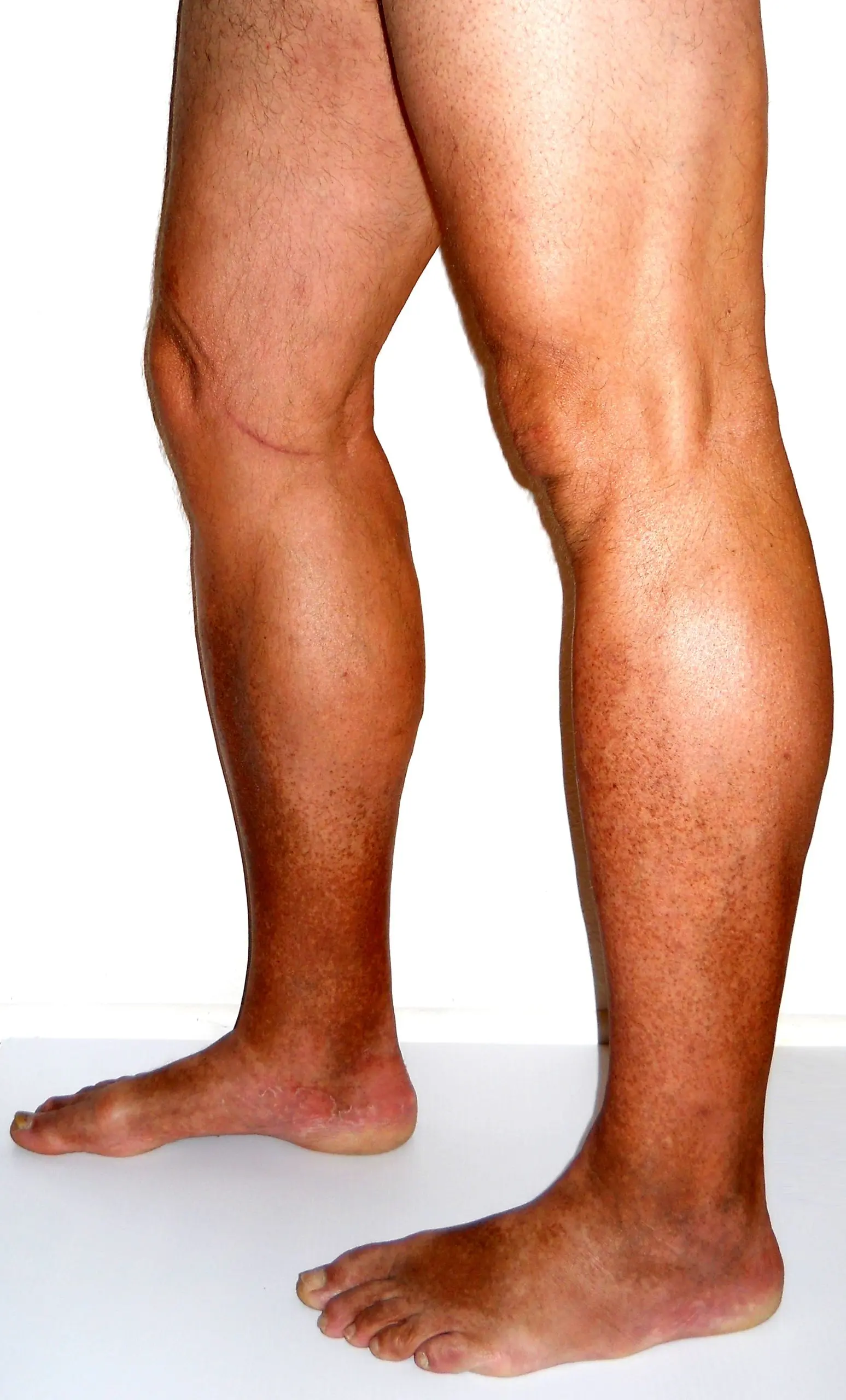 Chronic venous insufficiency