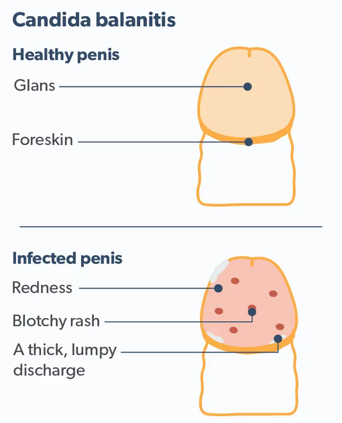 Circular glans inflammation &#8211; causes, location, treatment, prognosis