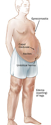 Cirrhosis of the liver &#8211; symptoms, hypertension, ascites and edema