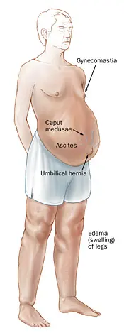 Cirrhosis of the liver &#8211; symptoms, hypertension, ascites and edema