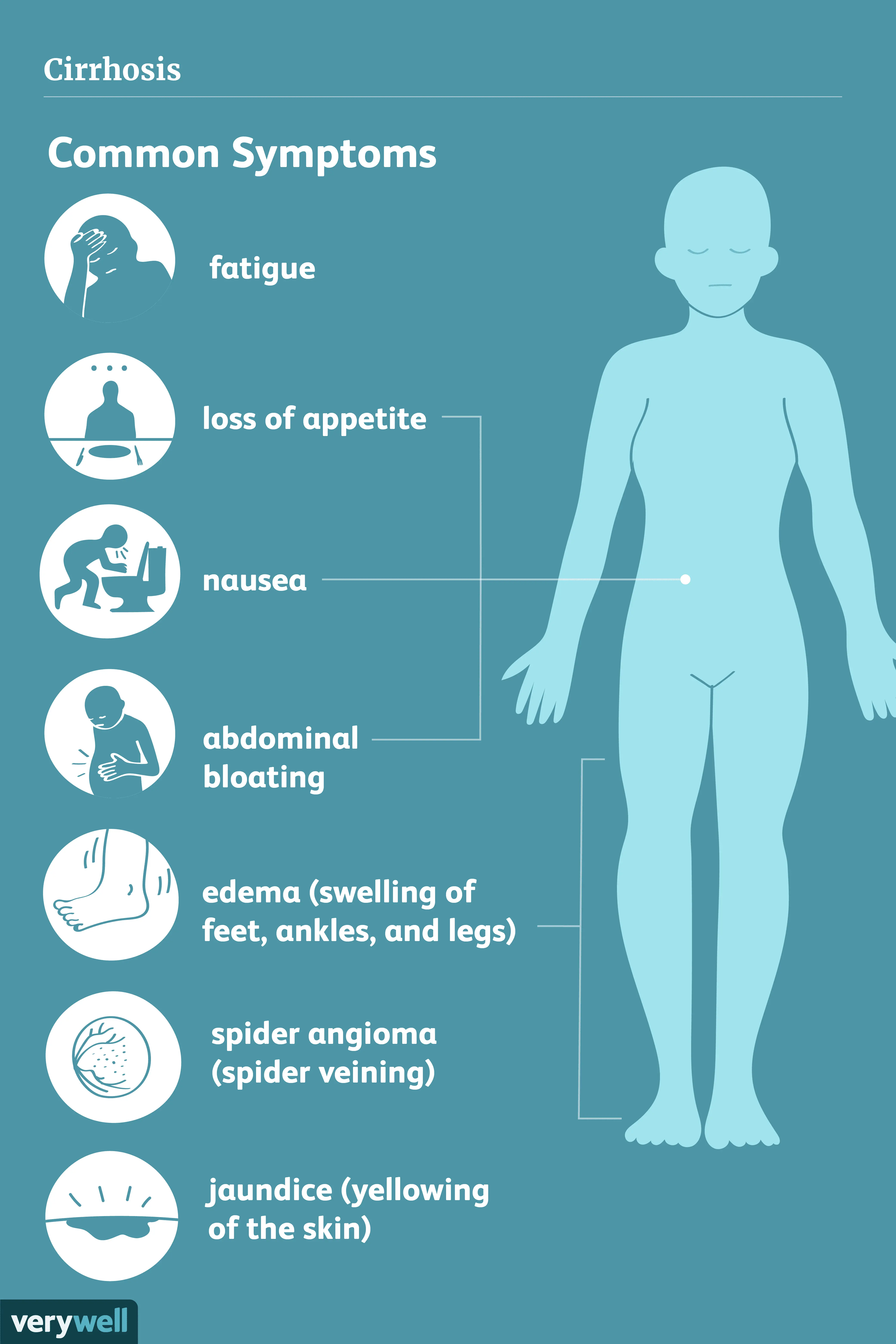 Cirrhosis of the liver &#8211; the most common symptoms. How is cirrhosis of the liver treated?