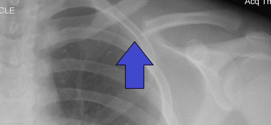 Clavicle fracture