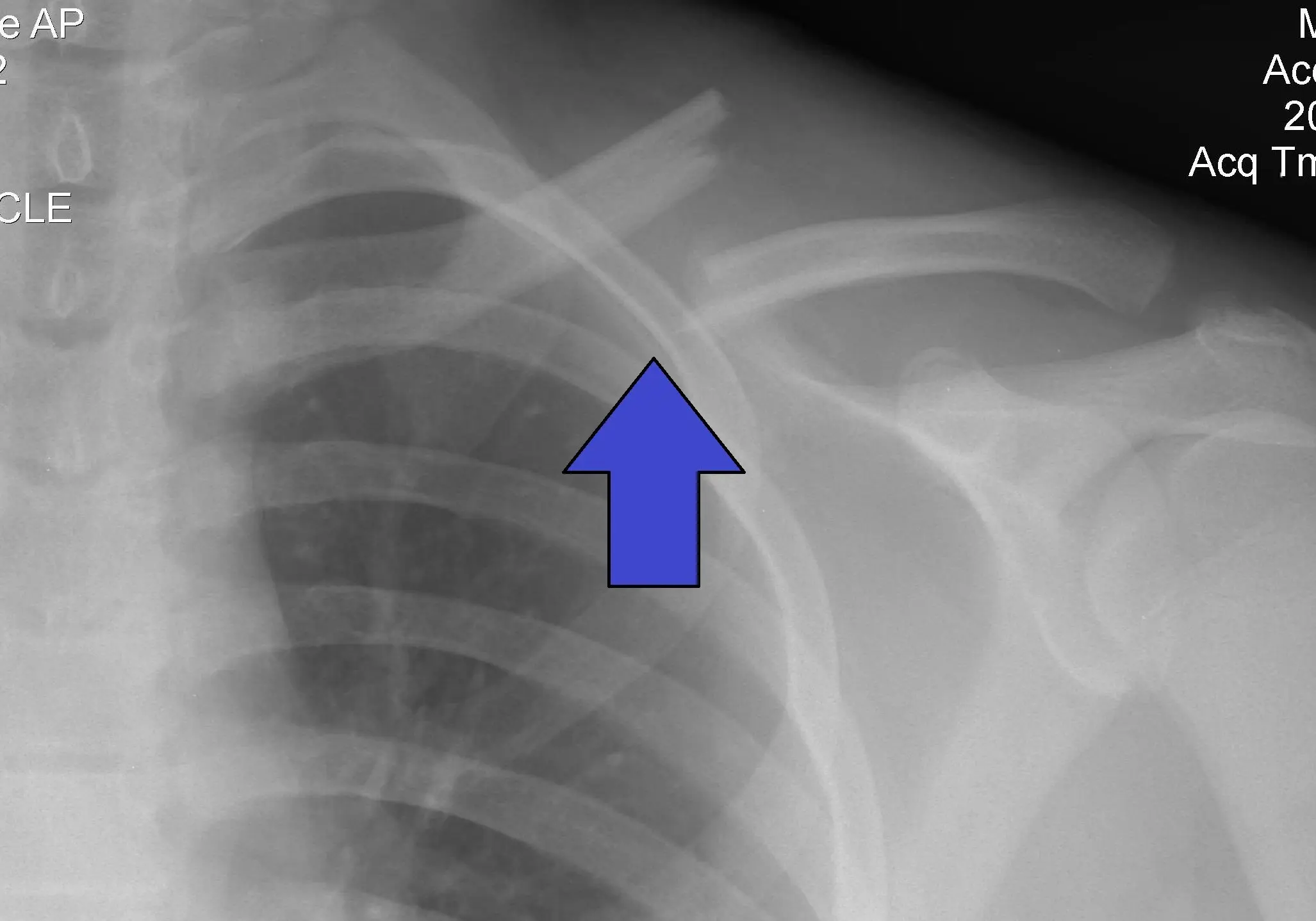 Clavicle fracture