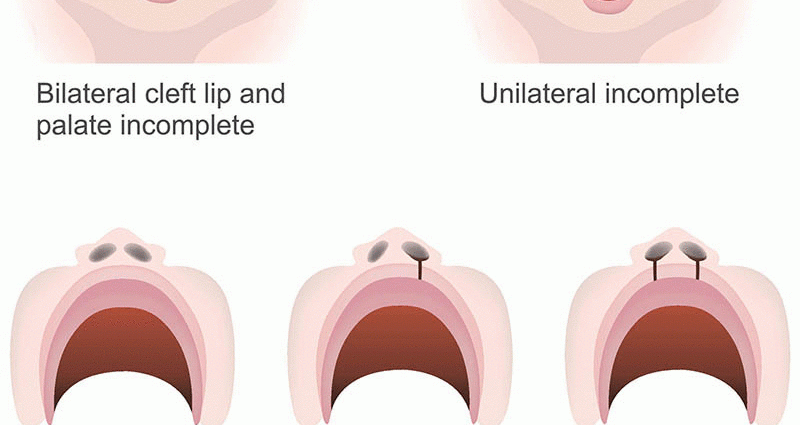 Cleft lip &#8211; types, symptoms, causes, treatment