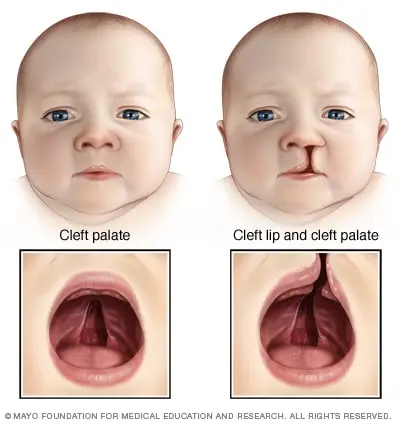 Cleft palate &#8211; symptoms, causes, treatment