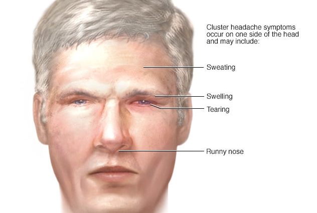 Cluster headache