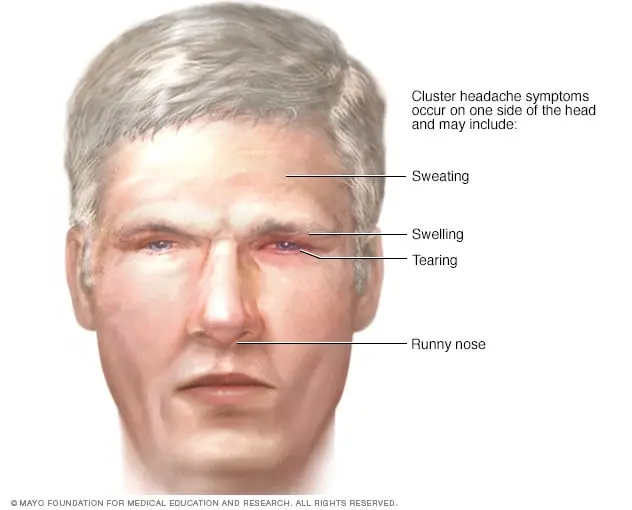 Cluster headache &#8211; causes, symptoms, treatment