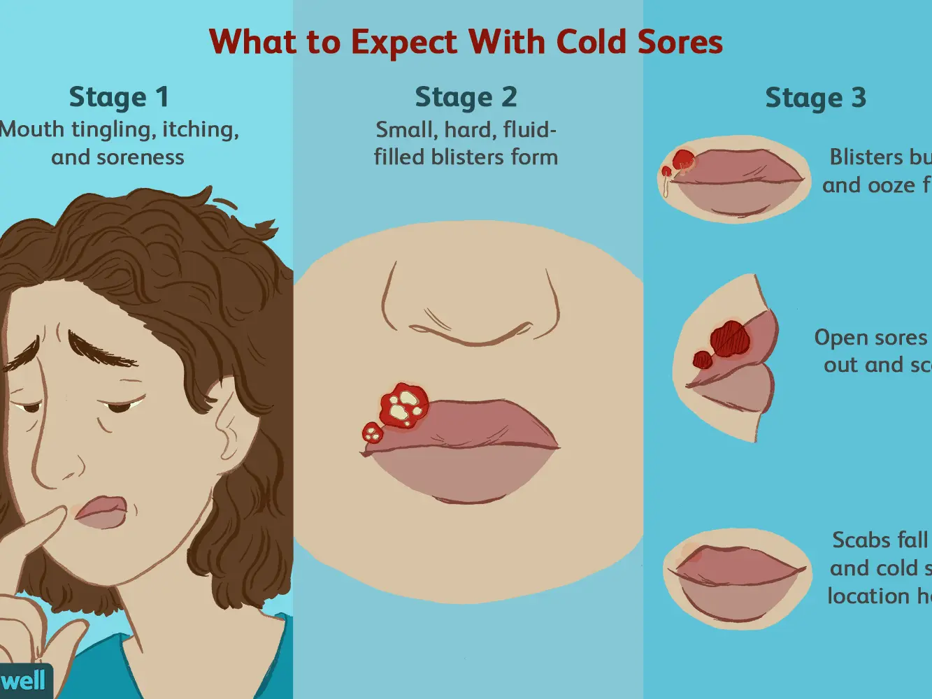 Cold sores &#8211; a small but persistent lesion. Where does it come from and what are the complications?