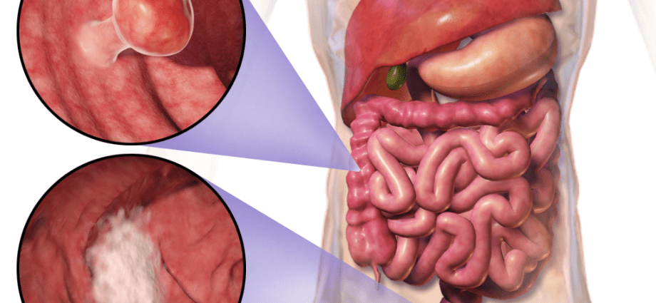 Colon cancer &#8211; causes, treatment, prognosis. What is the prevention of this cancer?