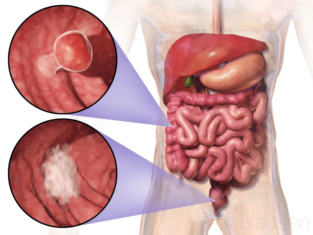 Colon cancer &#8211; causes, treatment, prognosis. What is the prevention of this cancer?