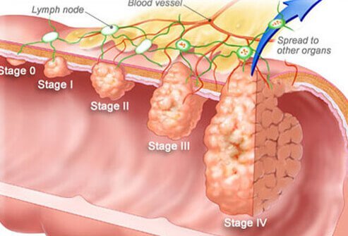 Colon cancer is dangerous because we don&#8217;t want to talk about it