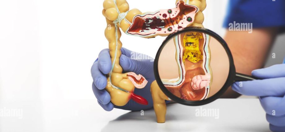 Colon cancer under a magnifying glass