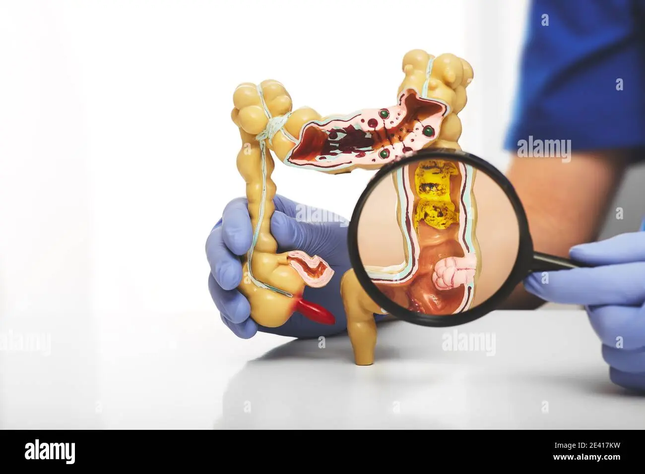 Colon cancer under a magnifying glass