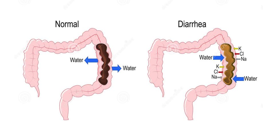 Colonic diarrhea