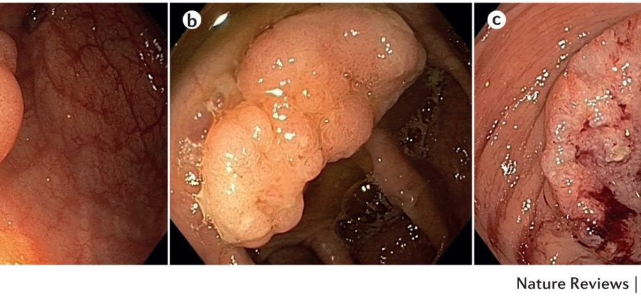 Colonoscopy is not space &#8211; &#8220;turn off&#8221; colorectal cancer