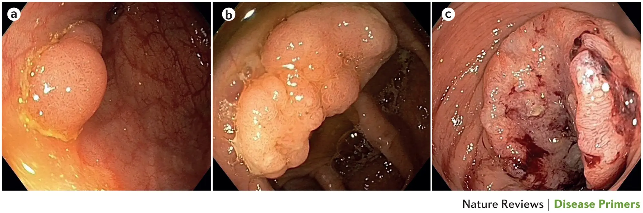 Colonoscopy is not space &#8211; &#8220;turn off&#8221; colorectal cancer