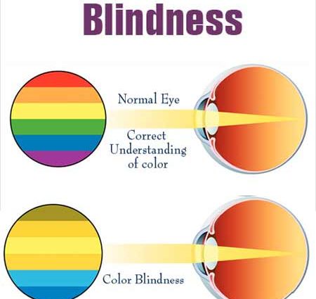 Color blindness &#8211; causes and symptoms. What is the treatment for color blindness?