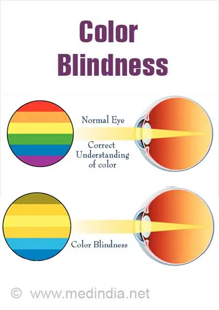 Color blindness &#8211; causes and symptoms. What is the treatment for color blindness?