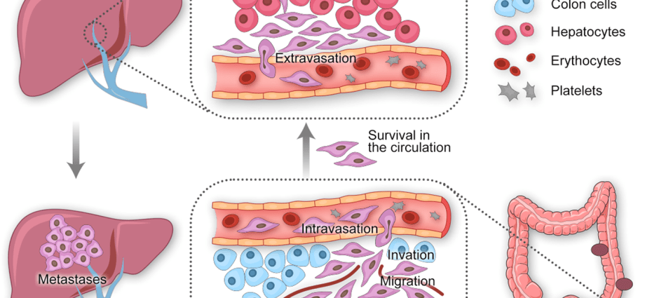 «Colorectal cancer is almost completely preventable». The new method gives hope