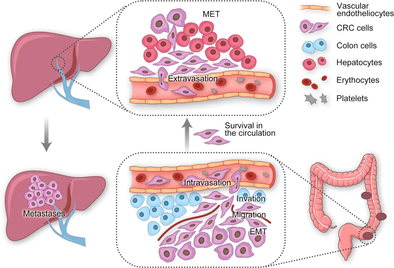 «Colorectal cancer is almost completely preventable». The new method gives hope