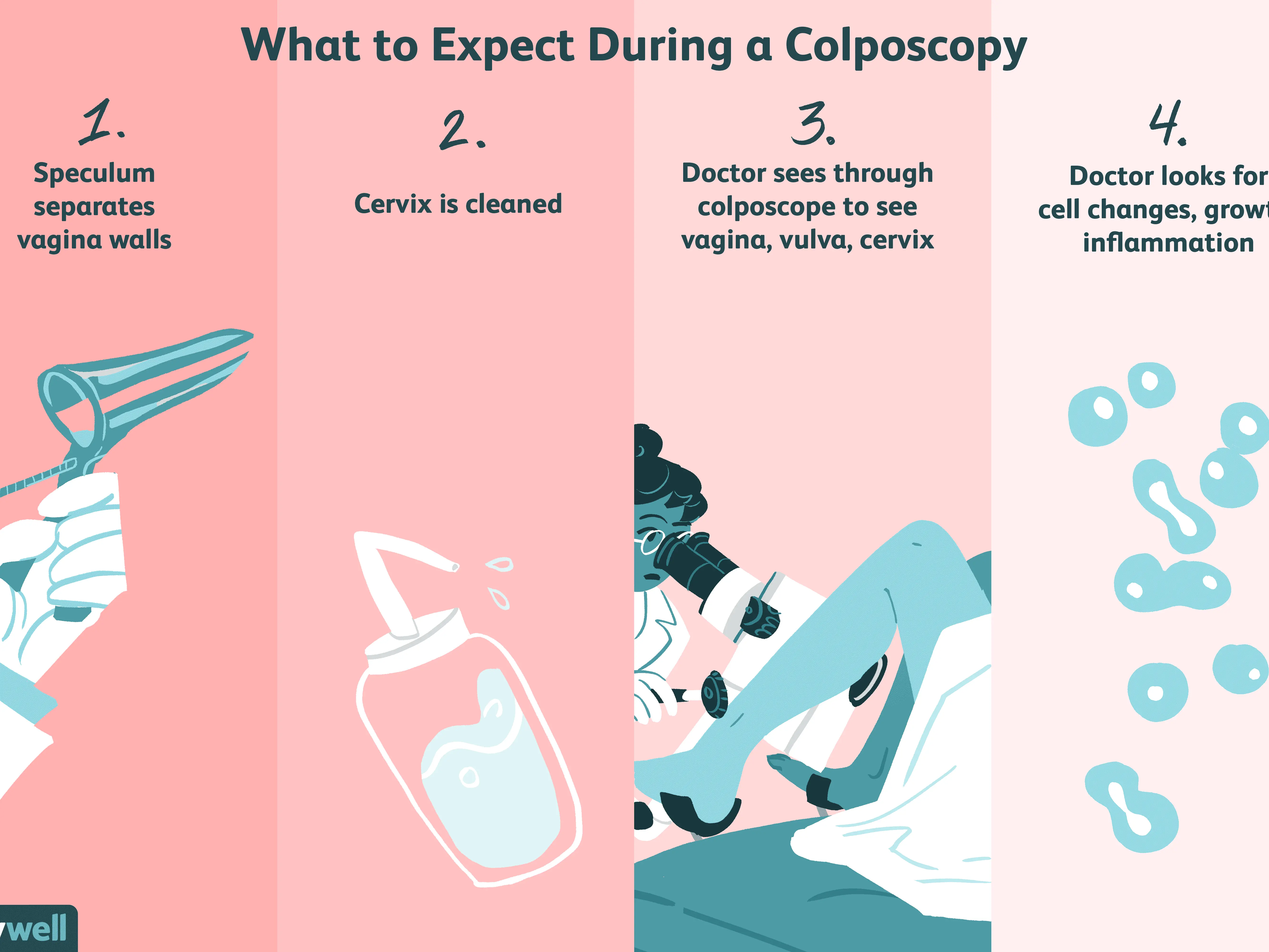 Colposcopy &#8211; indications, course, risks and side effects. How to prepare for a colposcopy?