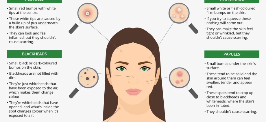 Common acne &#8211; causes, symptoms, treatment