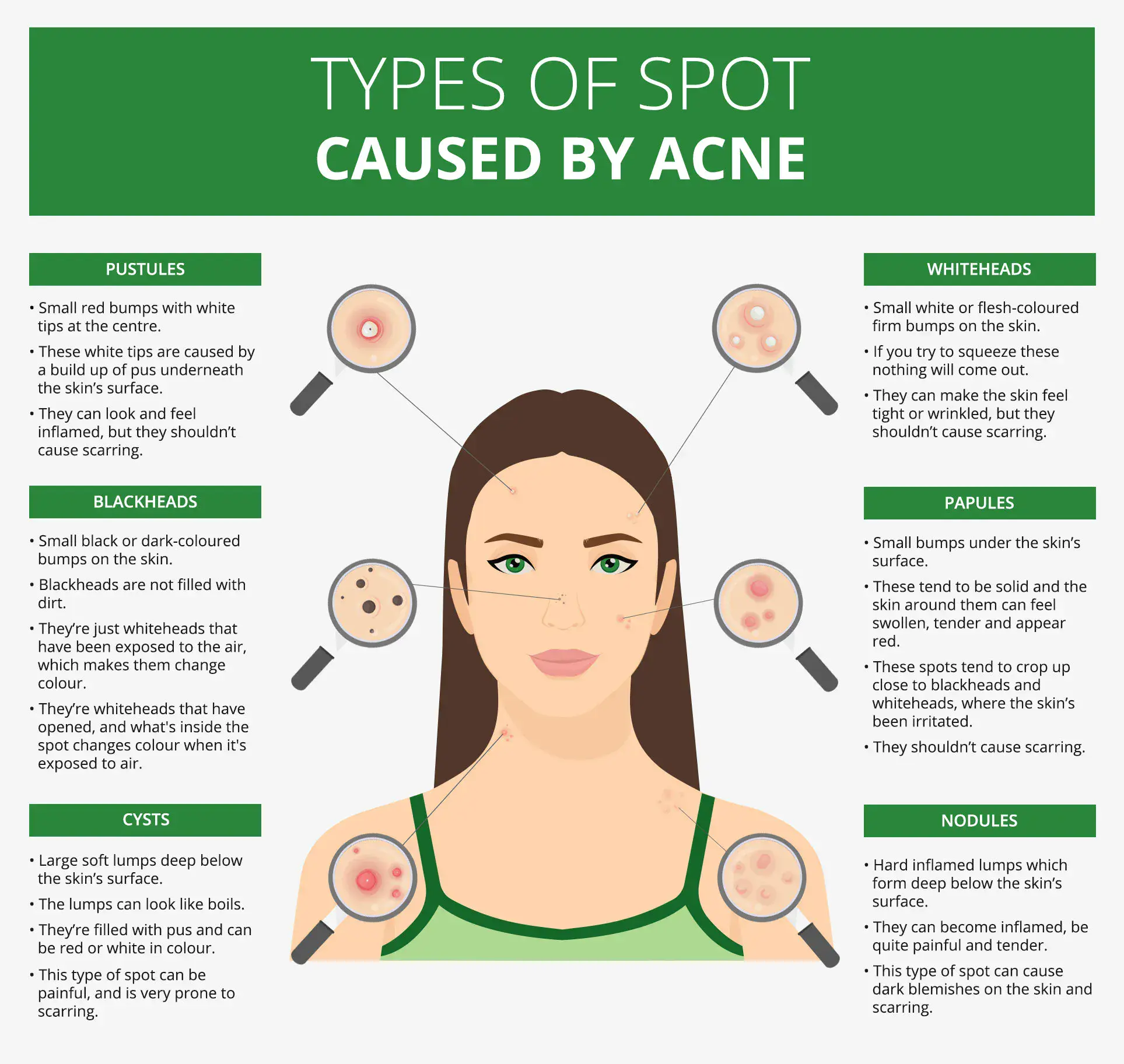 Common acne &#8211; causes, symptoms, treatment