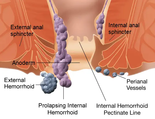 Common hemorrhoids