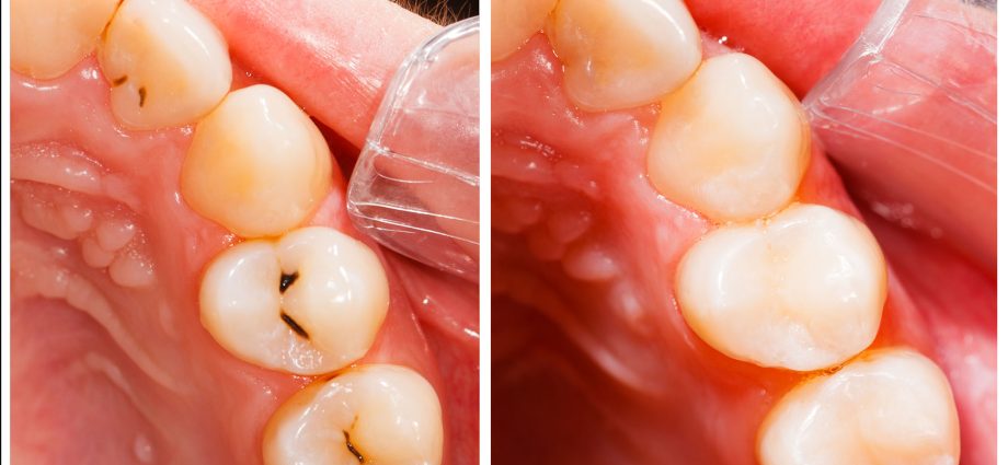 Composite fillings &#8211; characteristics, advantages, disadvantages, price