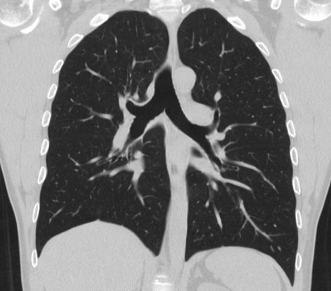 Computed tomography more effective than the coronavirus test?