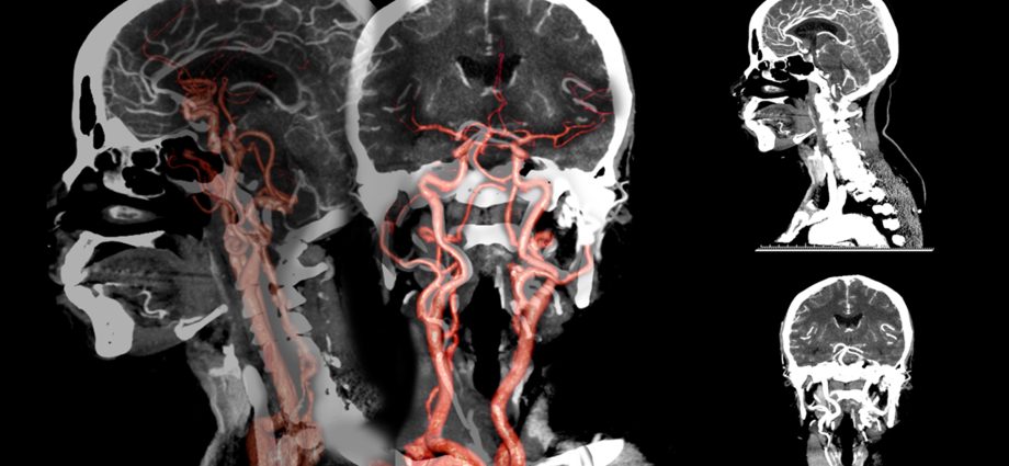 Computed tomography of blood vessels &#8211; what does the angio-CT examination look like?