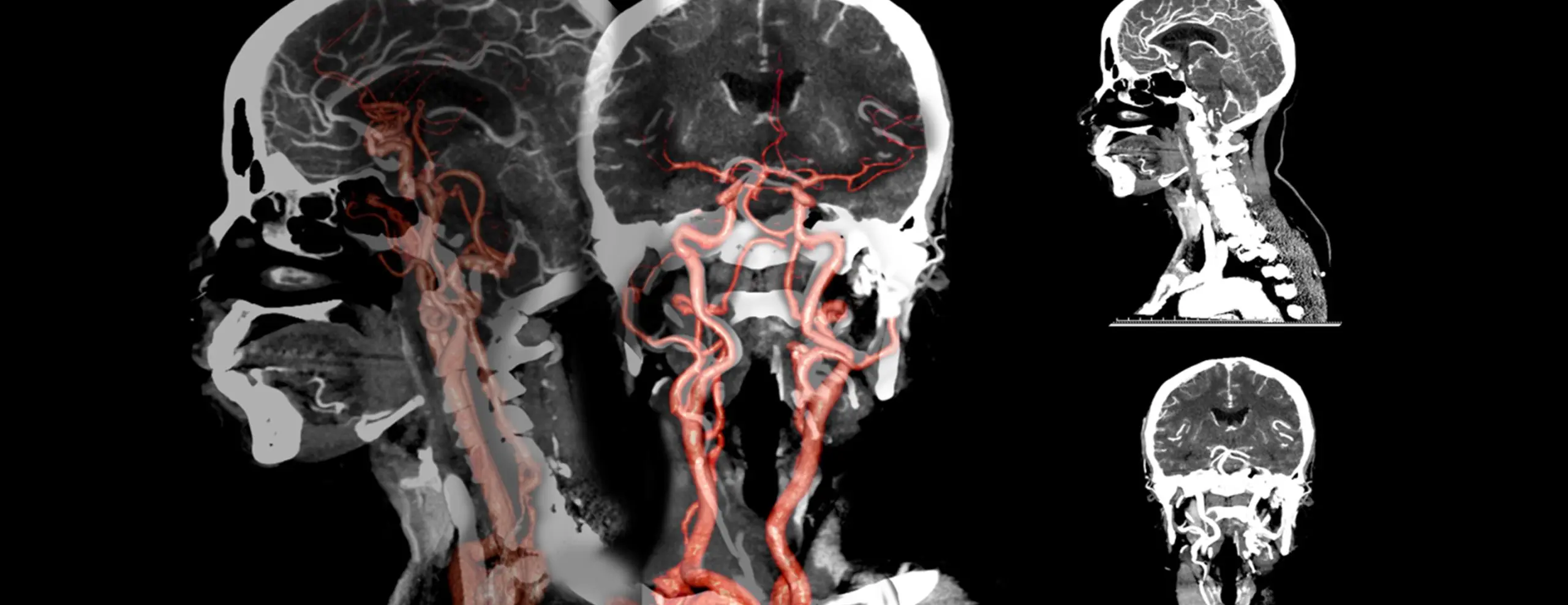 Computed tomography of blood vessels &#8211; what does the angio-CT examination look like?