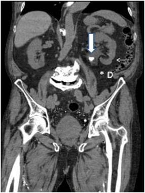 Computed tomography of the abdominal cavity &#8211; with or without contrast, duration, indications, contraindications