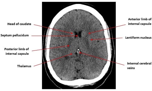 Computed tomography of the head &#8211; how to interpret the results?