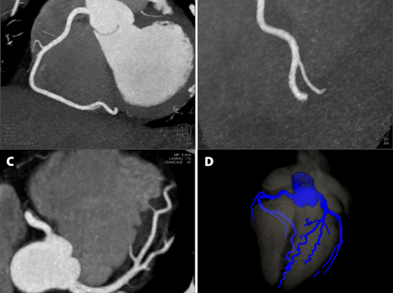 Computed tomography of the heart &#8211; an alternative to coronography. When to perform and how is a cardiac CT performed?